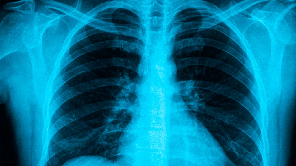 Nurturing Your Lung Resilience
